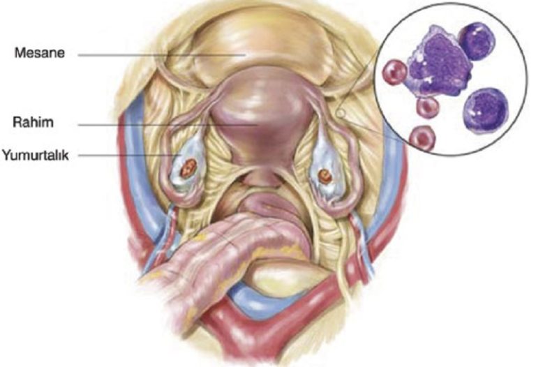 Kadın Üreme Sistemi Kanserleri
